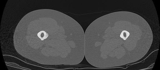 Bisphosphonate Cortical Thickening